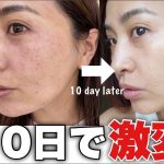 【シミ治療】43歳フォトフェイシャルで美肌✨ 10日間でここまで変わった経過を見せます。【美容医療】