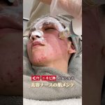 ポテンツァで美肌メンテ ＃美容ナース ＃毛穴ケア ＃アズクリニック