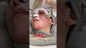 ポテンツァで美肌メンテ ＃美容ナース ＃毛穴ケア ＃アズクリニック